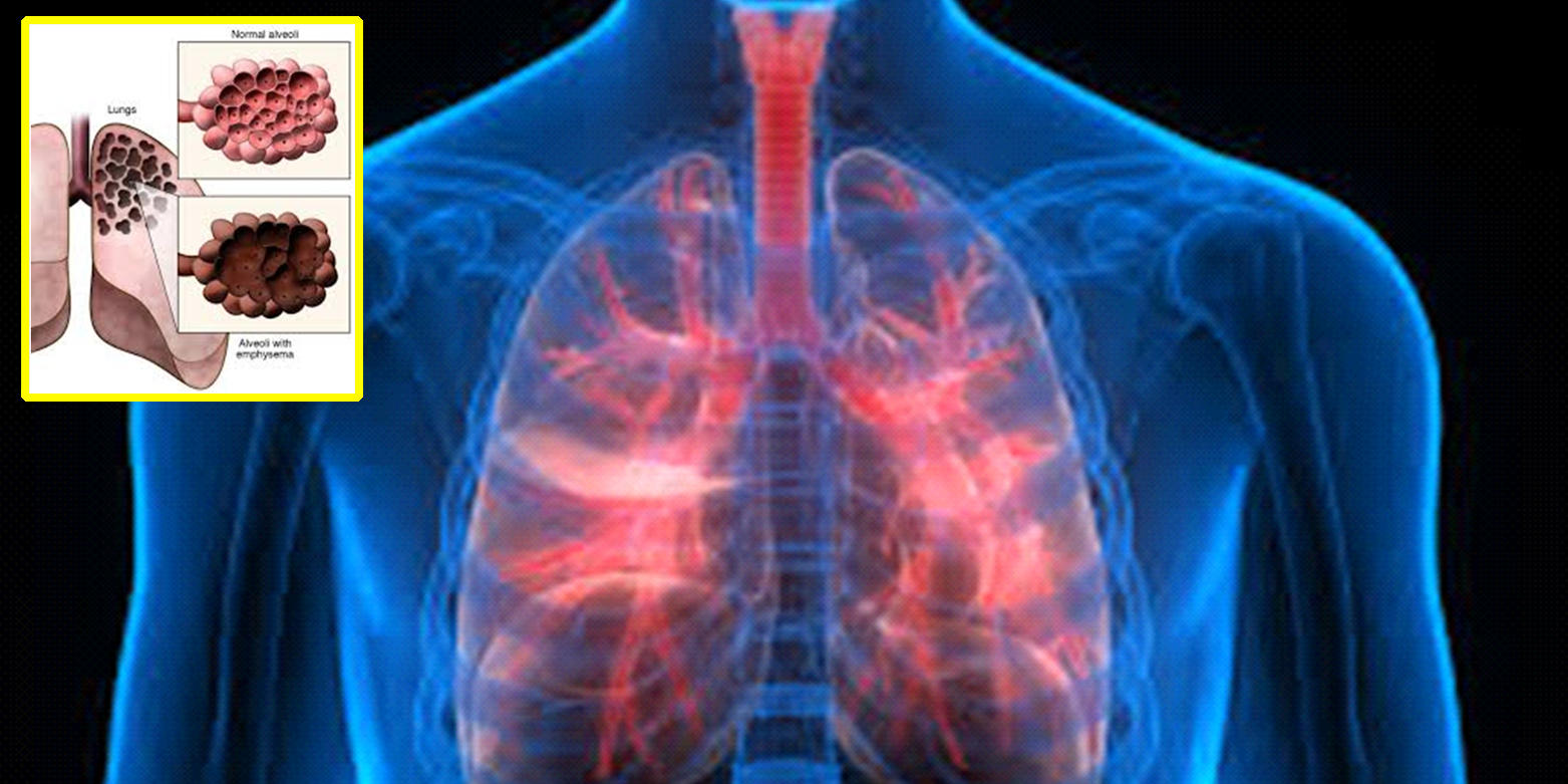 Chronic Obstructive Pulmonary Disease(COPD) Treatment in Indore, Top Chronic Obstructive Pulmonary Disease Doctors in Indore, Copd Treatment, Copd Diagnosis In Indore, Chronic Obstructive Pulmonary Disease (copd) Treatment In Indore, Doctors for COPD in Indore, Best Pulmonologists in Indore, Best Doctors for Copd Treatment in Indore, Best Lung specialists in Indore, Pulmonologists Doctors in Indore, Chest Physician in Indore